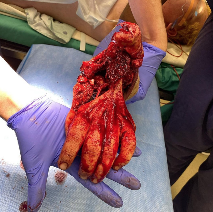 ATV accident