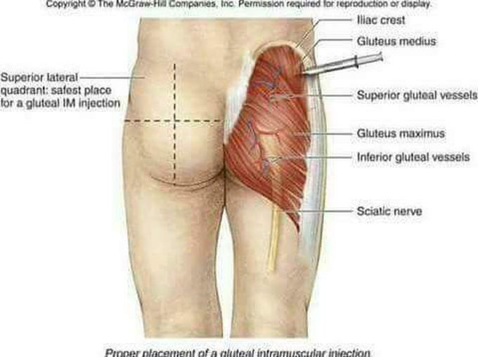 Gluteal intramuscular injection