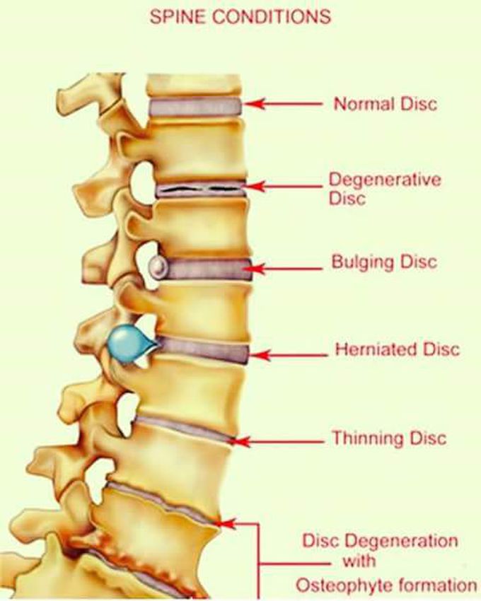 Spinal cord conditions