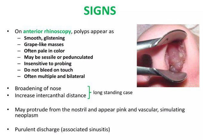 Nasal polps-Signs