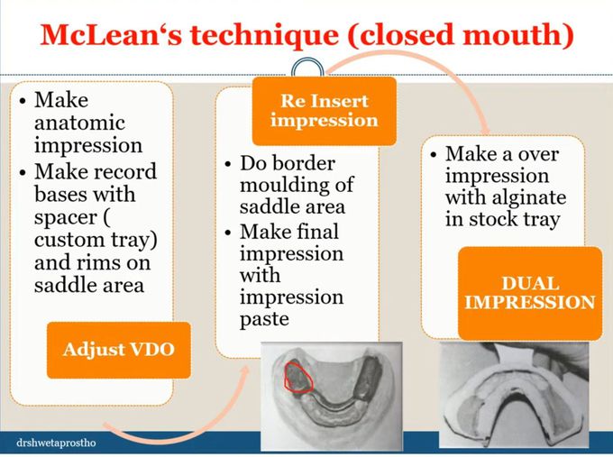 McLean's Technique