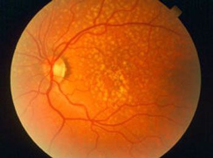 Degeneración macular