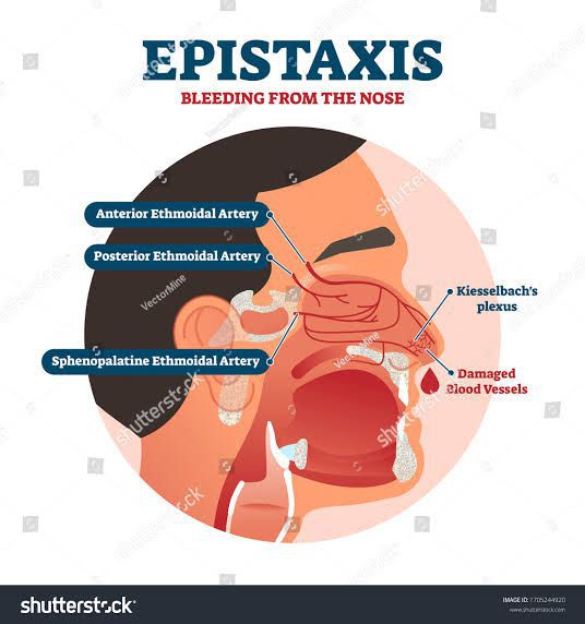 How to stop nose bleeding? - MEDizzy