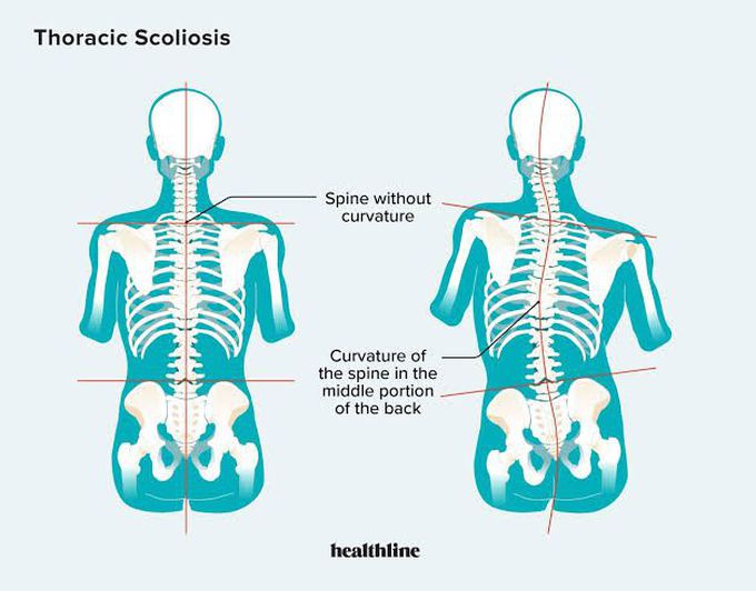 Three important signs of scoliosis