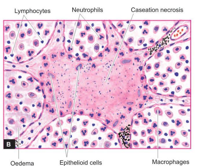 Bilateral tuberculous caseous pneumonia