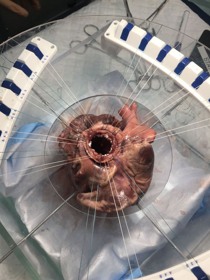 Prep work for an aortic heart replacement; Stanford medical school