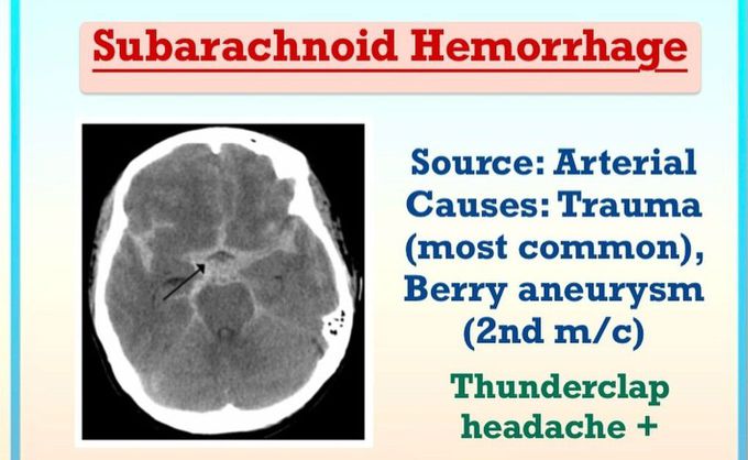 Subarachnoid Hemorrhage