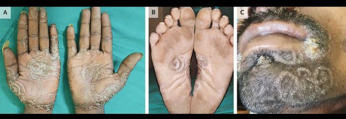 Circinate Syphilitic Lesions