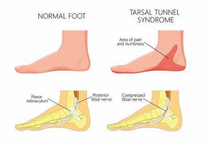 Difference between a normal foot and foot with Tarsal Tunnel