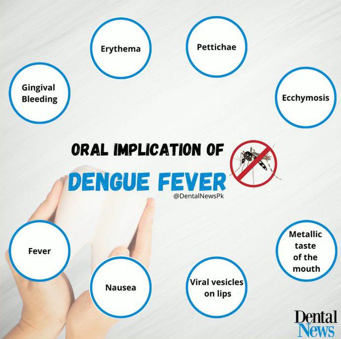 Oral Implications of Dengue Fever