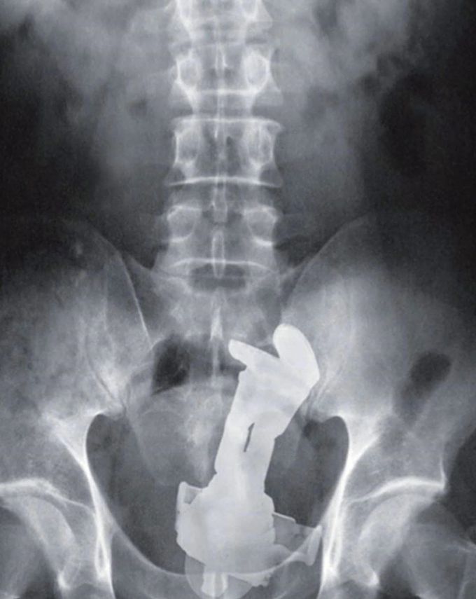 Rectal foreign body! Can you name the object?  