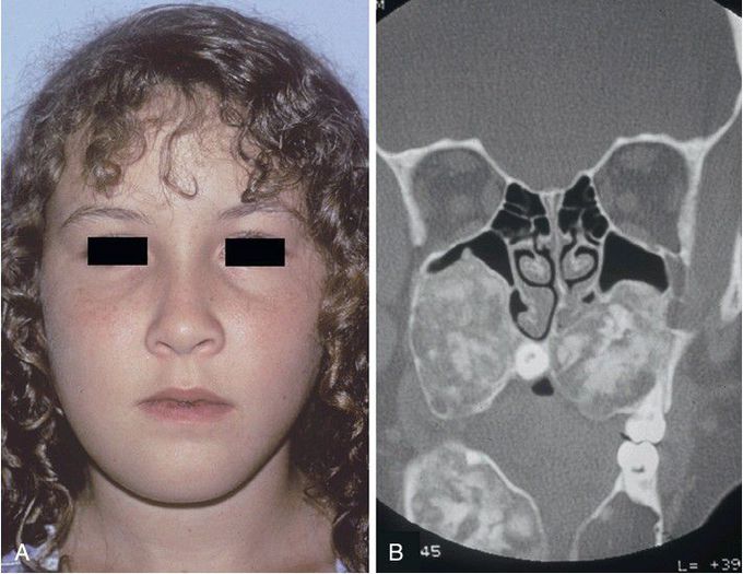 Familial Gigantiform Cementoma