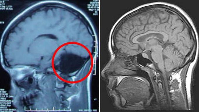 "A Woman Who lived Without A Cerebellum"