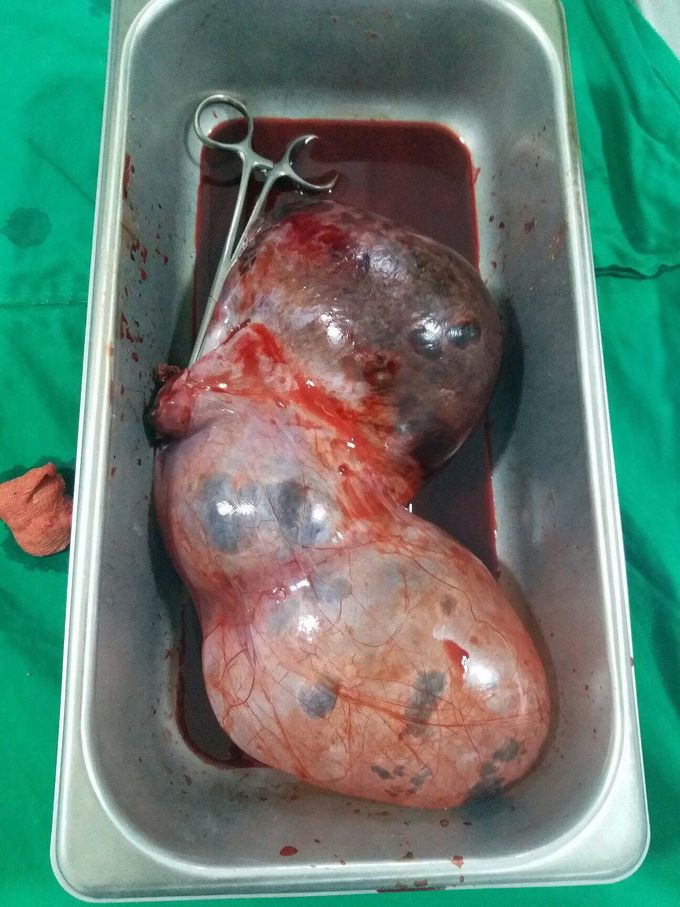 Torsion of huge ovarian cyst