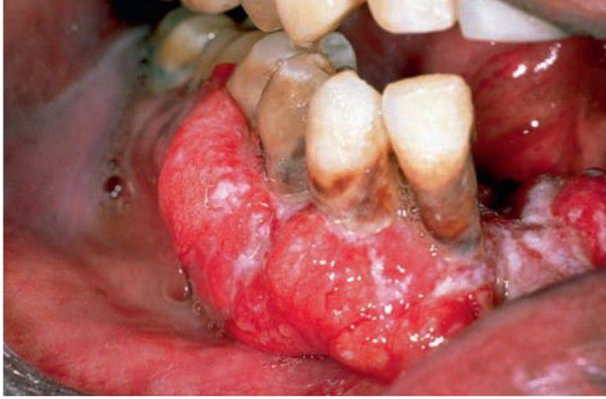 Squamous cell carcinoma of gingiva