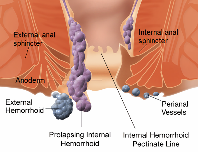 Hemorrhoid