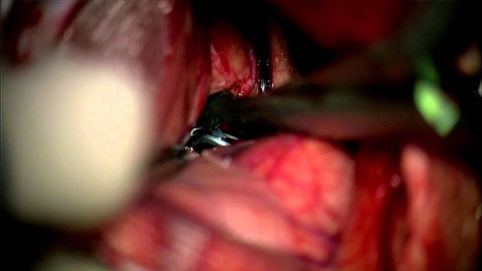 Clipping of bilat MCA & a coiled ACOM aneurysm thru a modified lat supraorbital