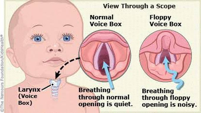 Symptoms of laryngomalacia