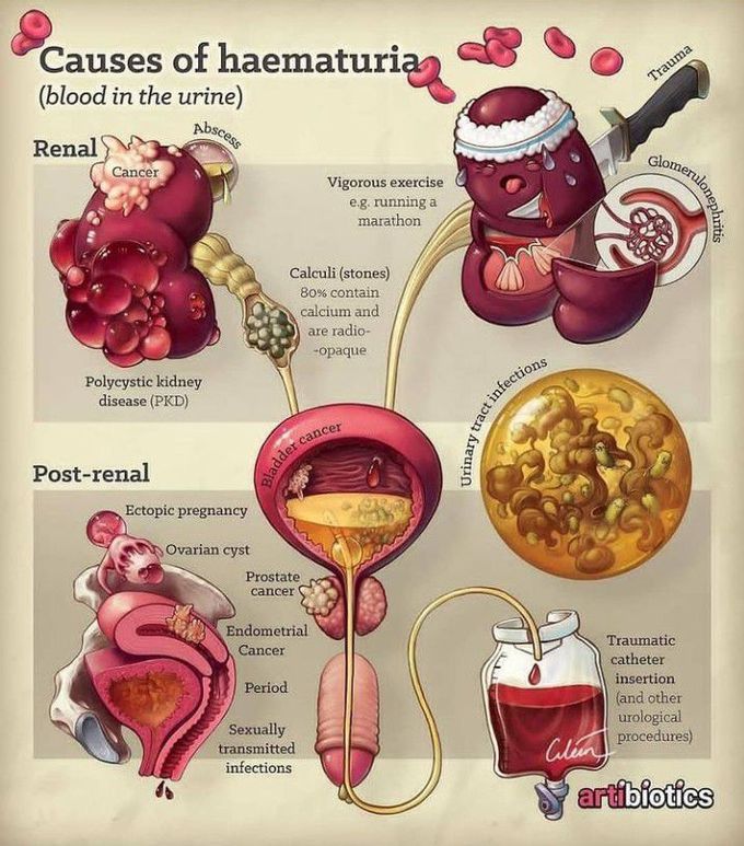 Causes of hematuria