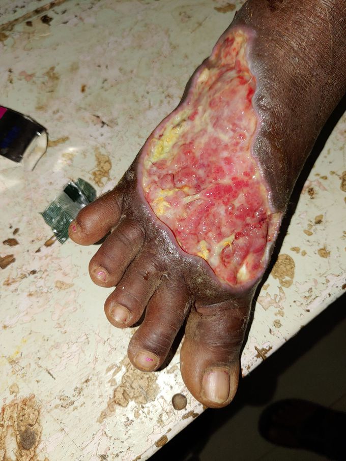 Do you believe guys its a snake bite case after snake bite of 4 days leg happen like this whats your diagnosis?????