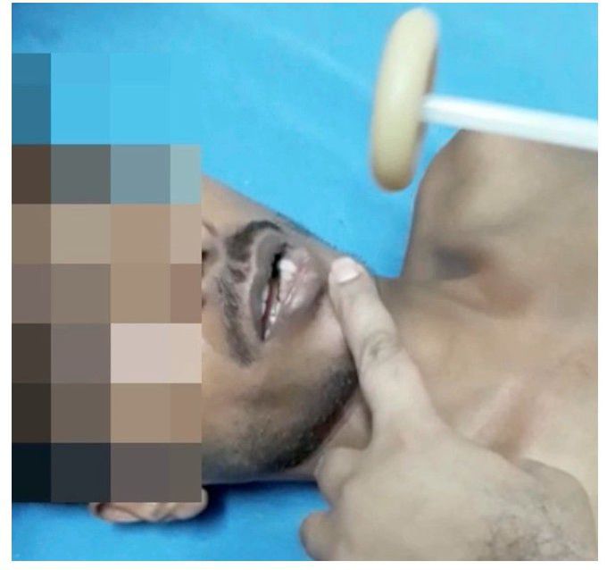 Jaw Clonus and Limb Fasciculations