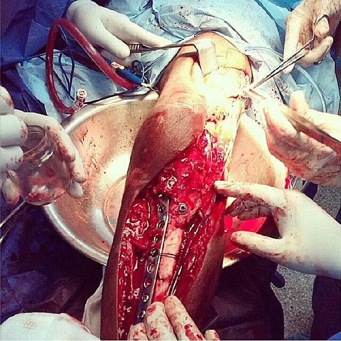 Fracture of tibia