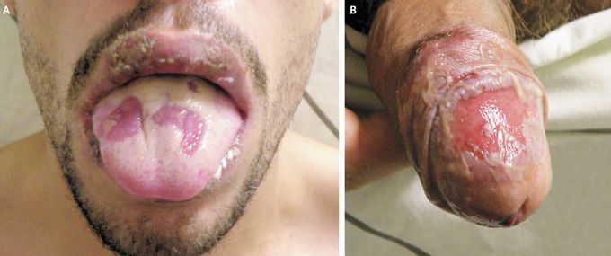 Oral and Genital Ulcers in Behçet’s Disease