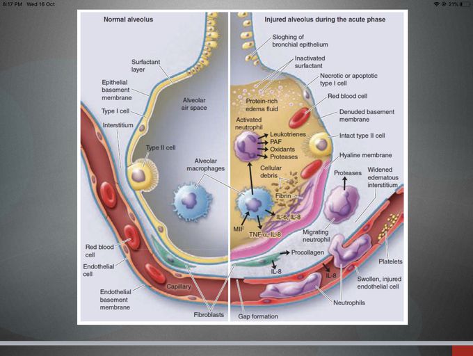 Injured alveoli