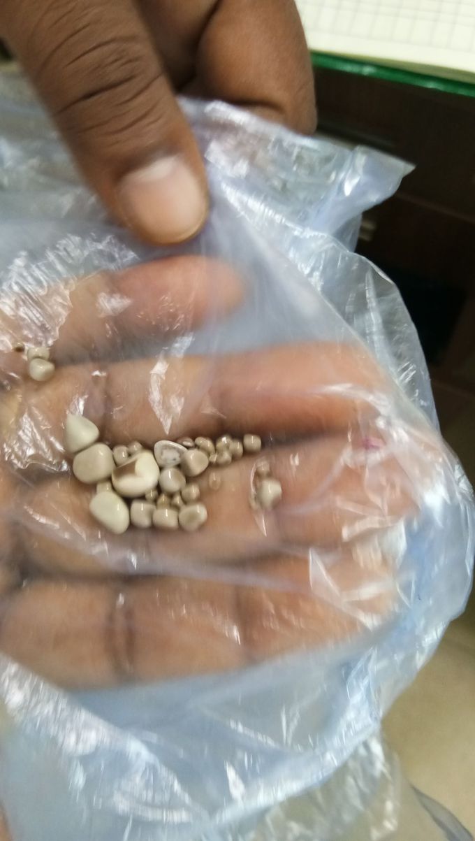 Can you believe this guy showed up today in opd with a history of passing these stones in urine
