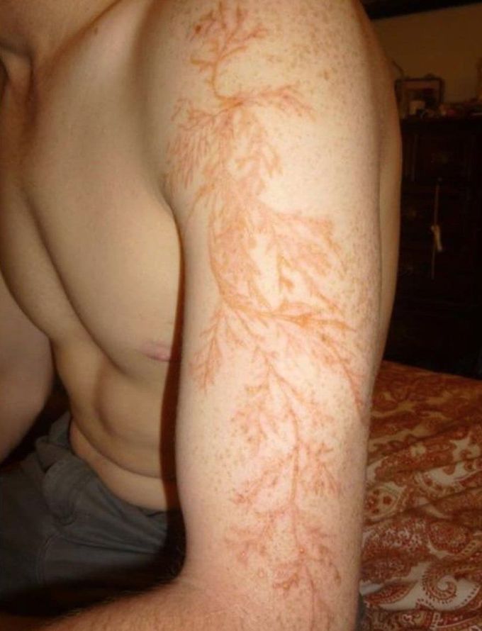 An unbelievable case of a lightning strike survivor!