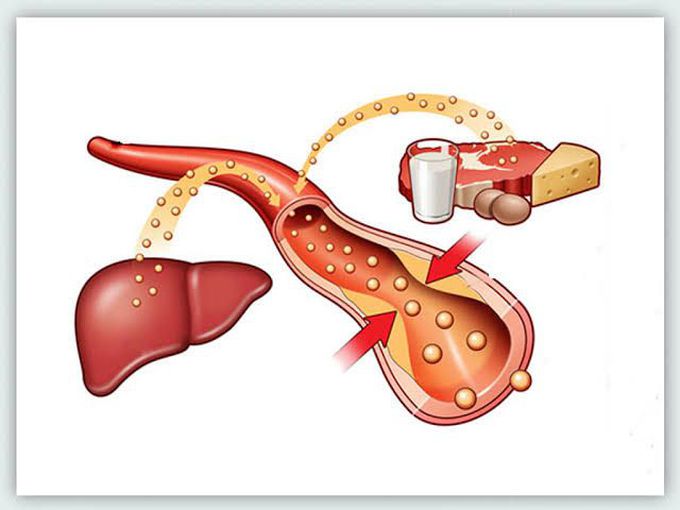 Hyperlipidemia causes