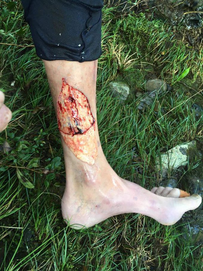 Result of a ‘foot entrapment’