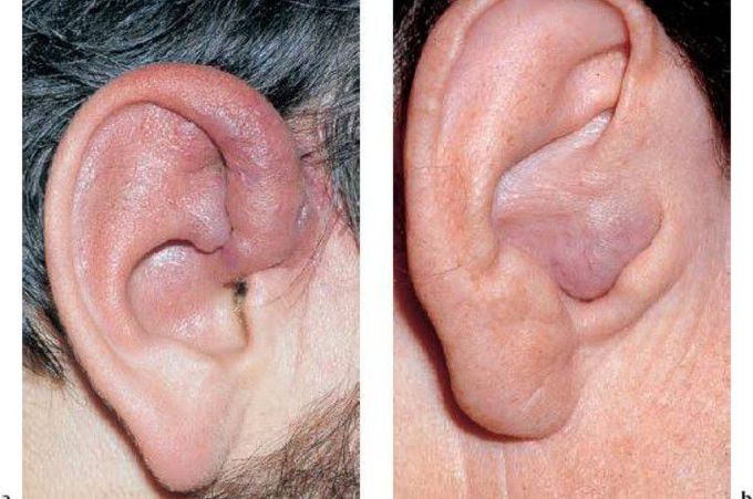 Cause of Ear tumor