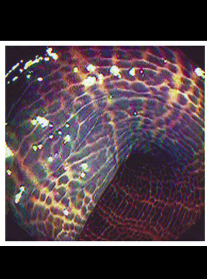Colonoscopy