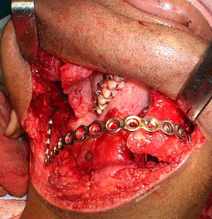 Mandibular plate implant!! 