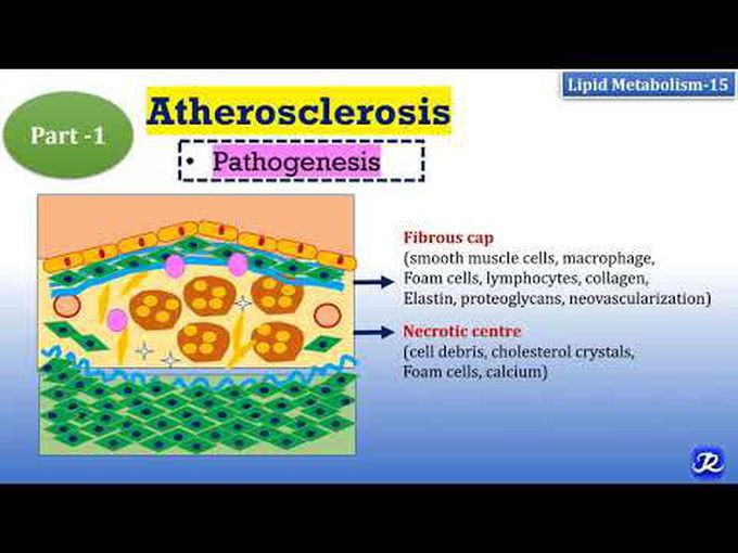 High cholesterol levels lead to atherosclerosis
