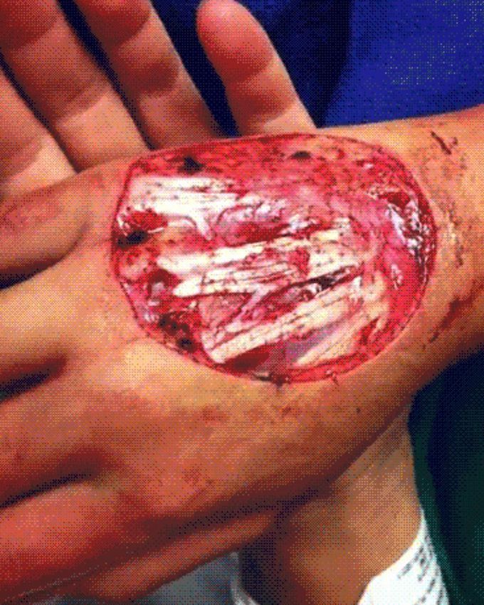 Exposed tendons!  