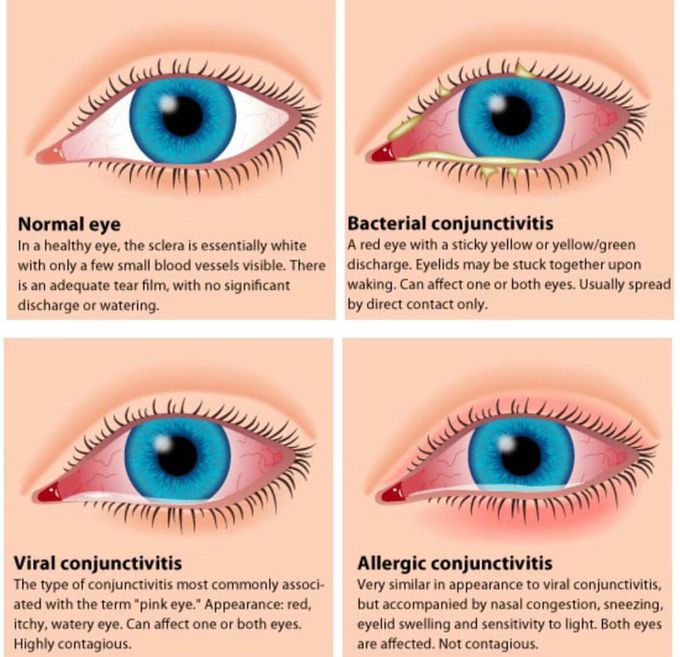 Causes of red eye and characteristics