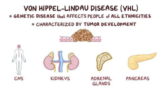 Von hippel lindau syndrome