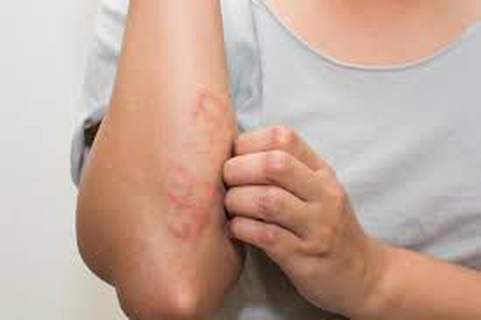 Symptoms of eczema