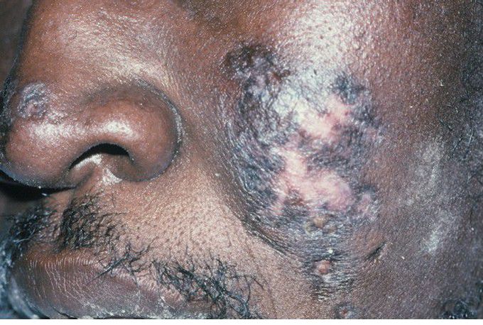 Chronic Cutaneous Lupus Erythematosus (CCLE).