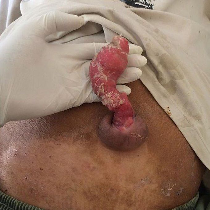 Granuloma