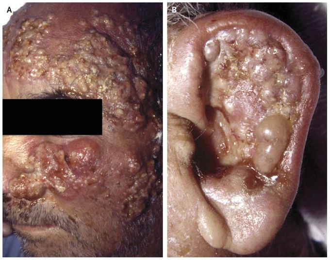 Iododerma from Contrast Material
