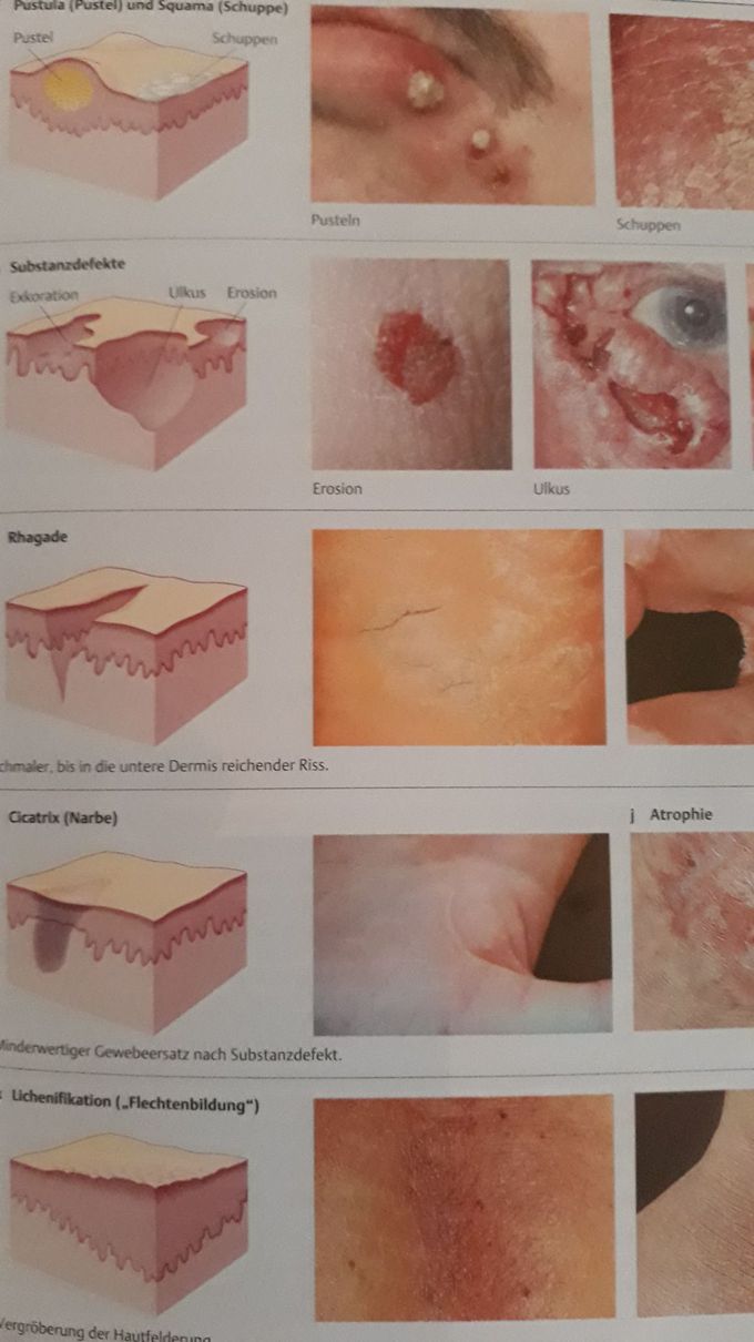 Secondary efflorescence (accept Pustula)