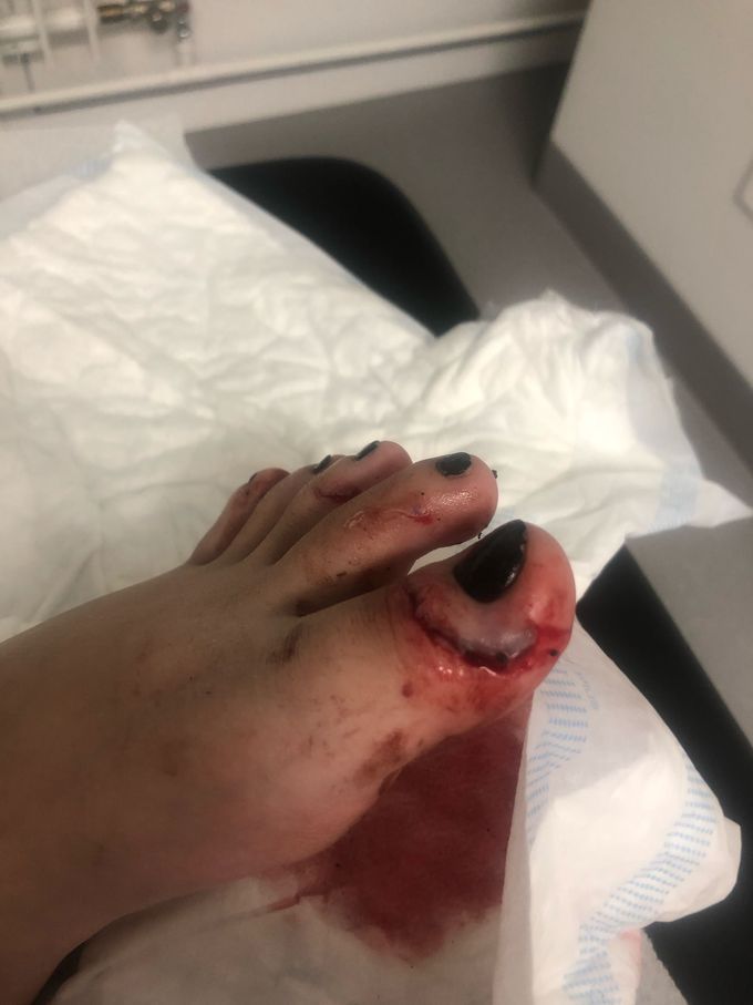 Wound from getting stuck under a bus-door!
