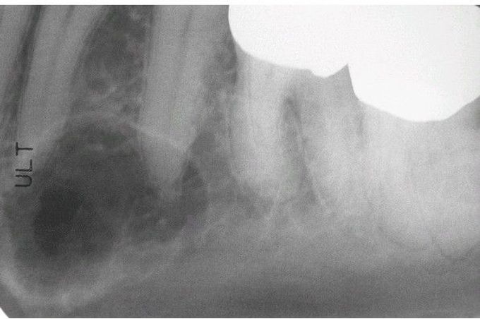 Intrabony Venous Malformation