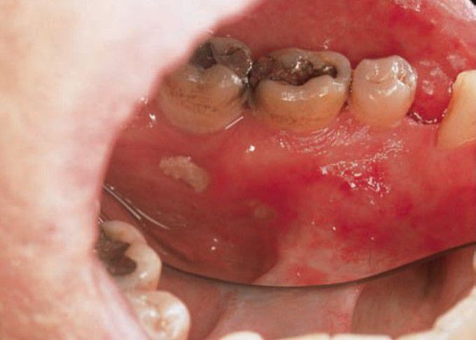 Post radiation osteoradionecrosis