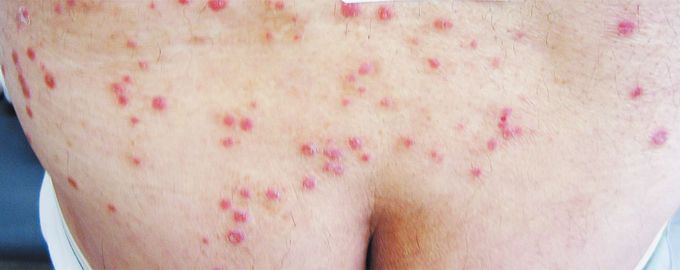 Psoriasis Flare from Koebner's Phenomenon after Acupuncture