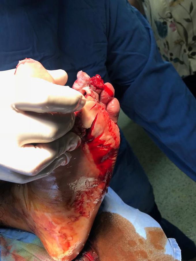 Motorcycle crash
