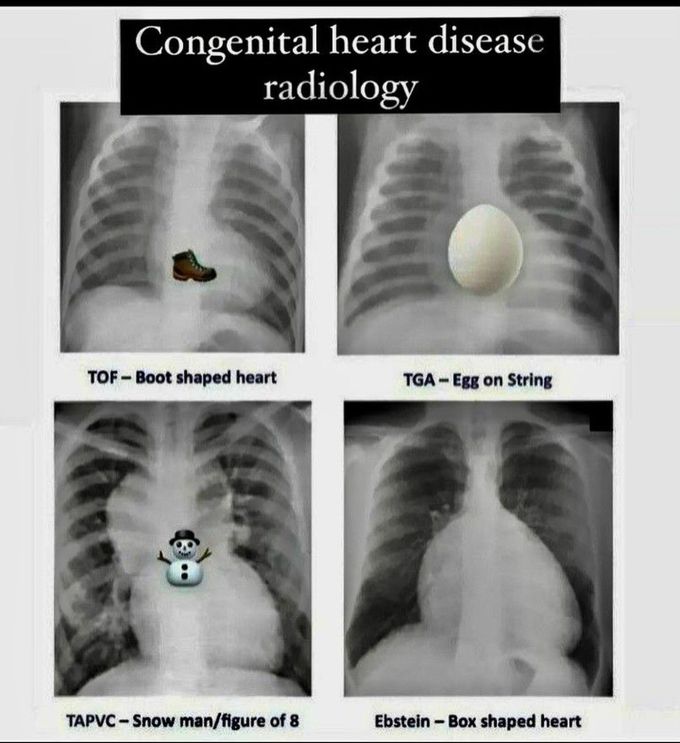 Congenital Heart Diseases -Radiology